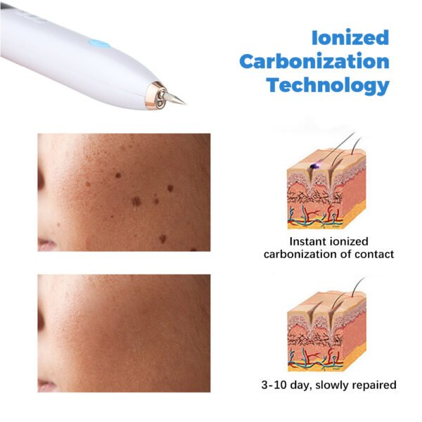 Laser Skin Tag, Mole and Freckle Remover - Image 6