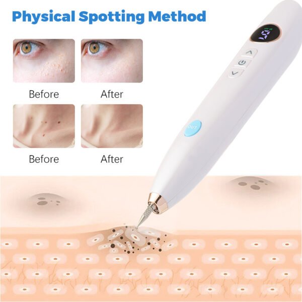 Laser Skin Tag, Mole and Freckle Remover