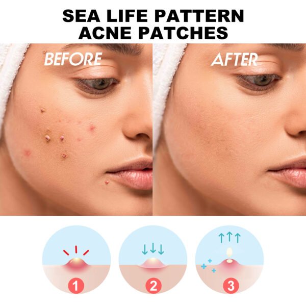 Acne Patches Reduce Acne & Pimples - Image 5